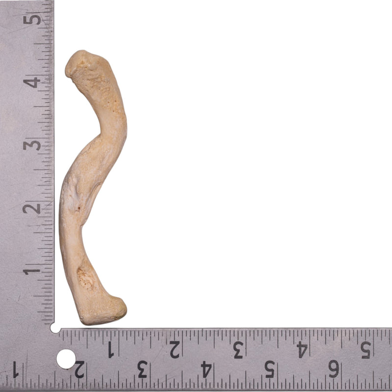 Real Human Clavicle - Pathology