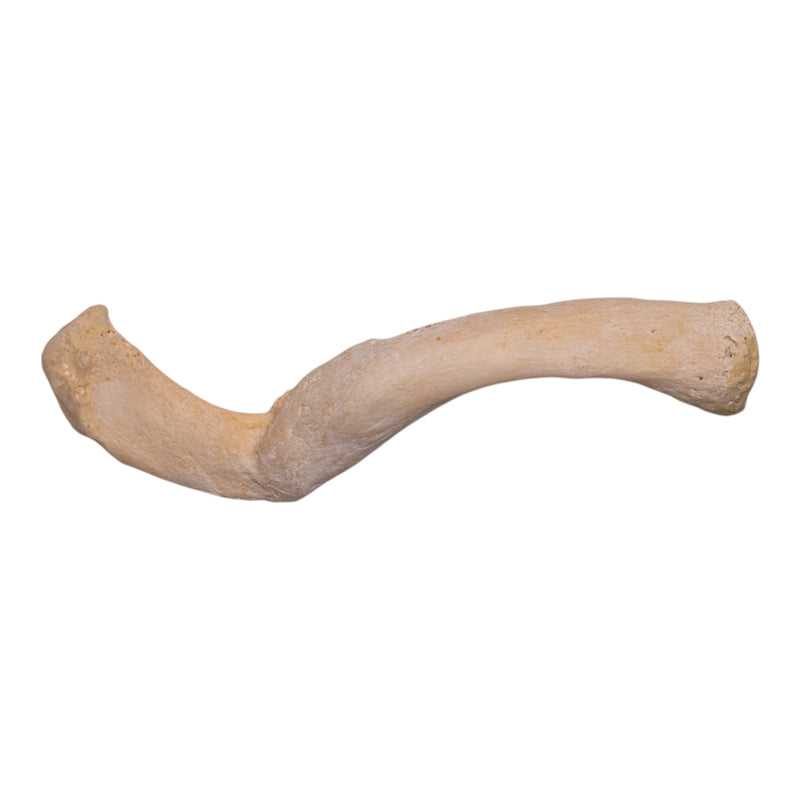 Real Human Clavicle - Pathology