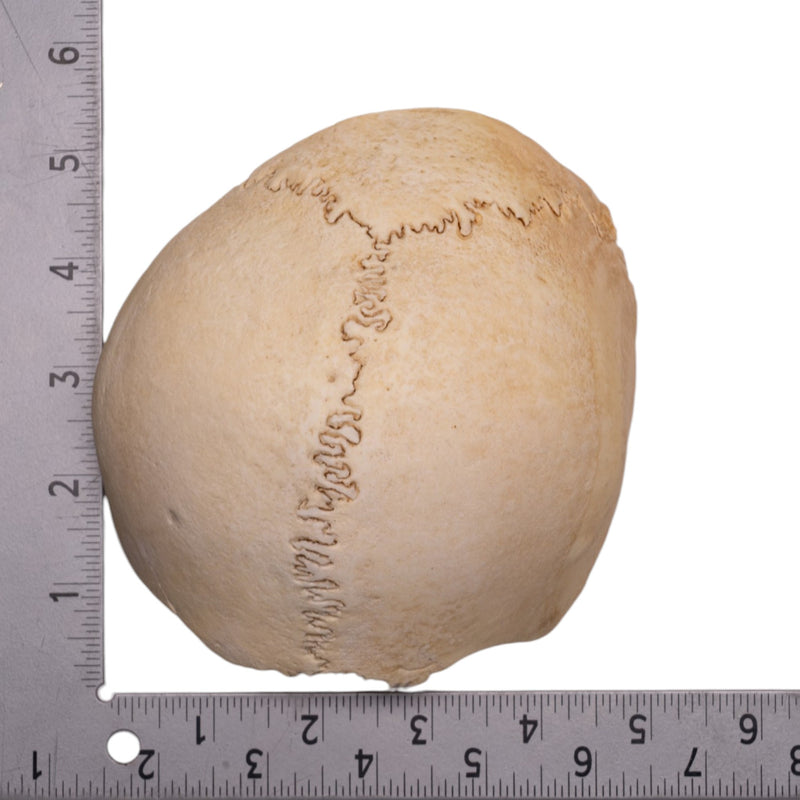 Real Human Partial Cranial Vault