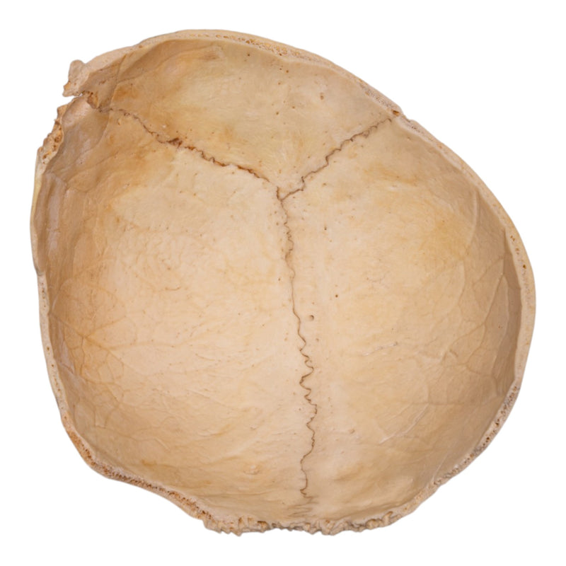 Real Human Partial Cranial Vault