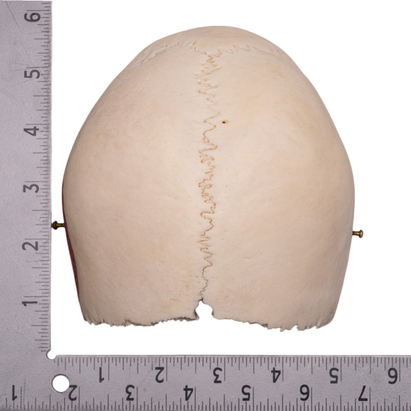 Real Human Partial Cranial Vault