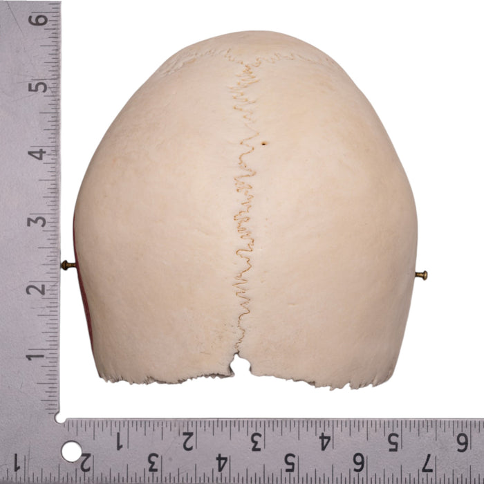 Real Human Partial Cranial Vault