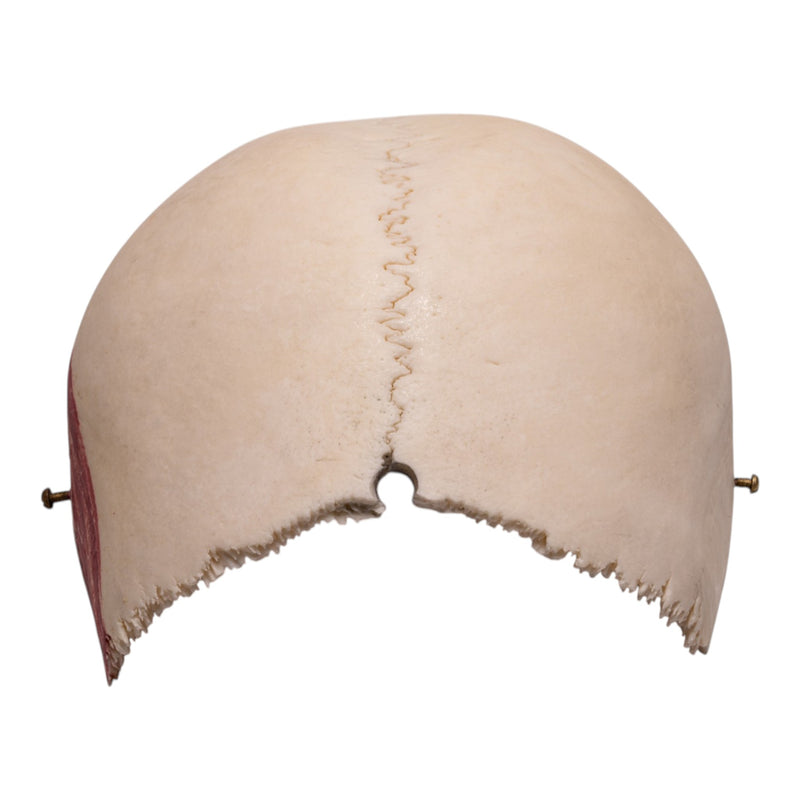 Real Human Partial Cranial Vault