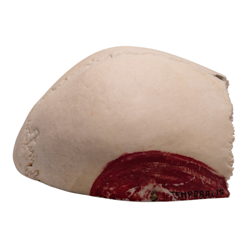 Real Human Partial Cranial Vault