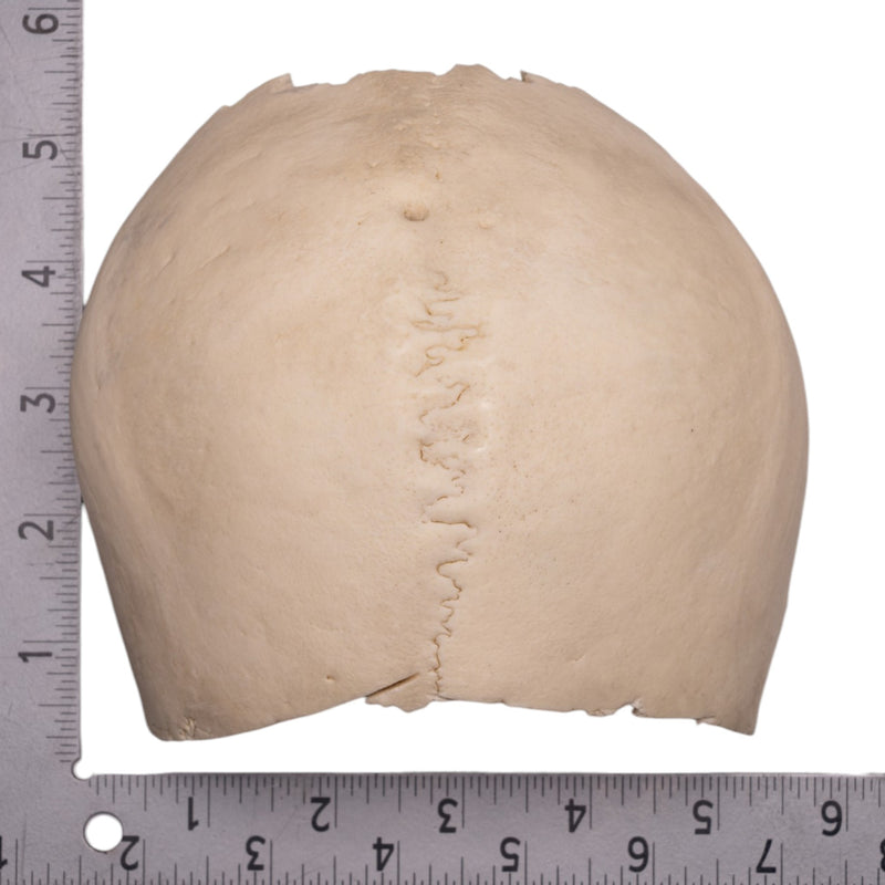 Real Human Partial Cranial Vault