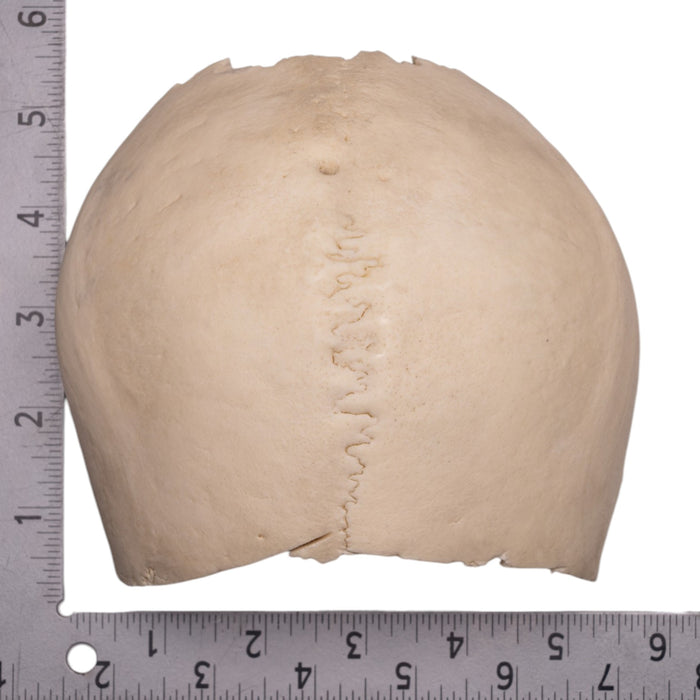 Real Human Partial Cranial Vault