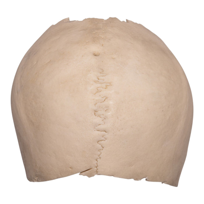 Real Human Partial Cranial Vault
