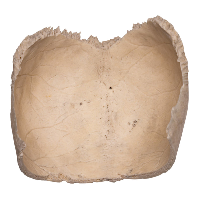 Real Human Partial Cranial Vault