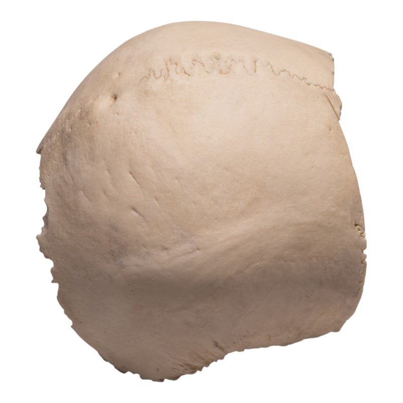 Real Human Partial Cranial Vault