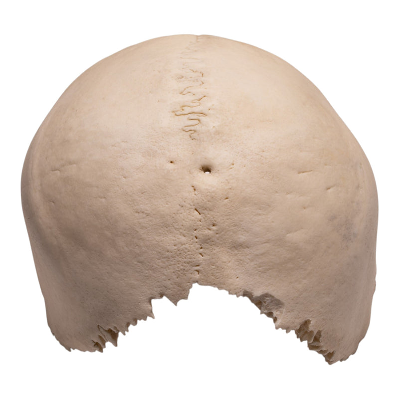 Real Human Partial Cranial Vault