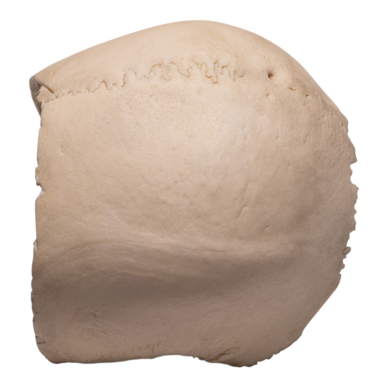 Real Human Partial Cranial Vault