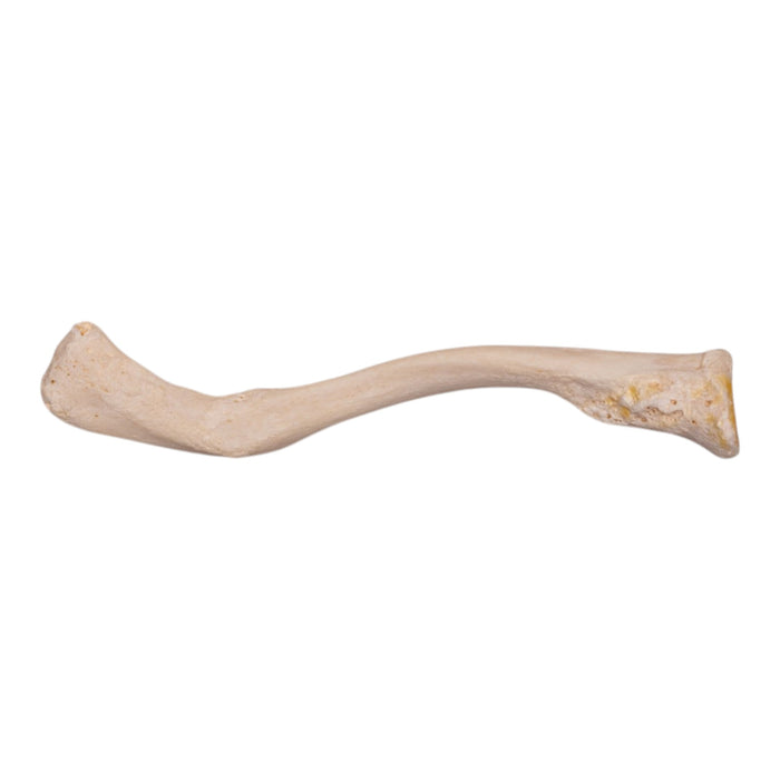 Real Human Clavicle - Pathology