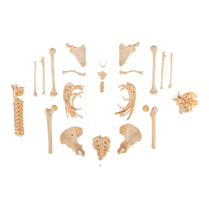Real Human Skeleton - Partial - Pathology