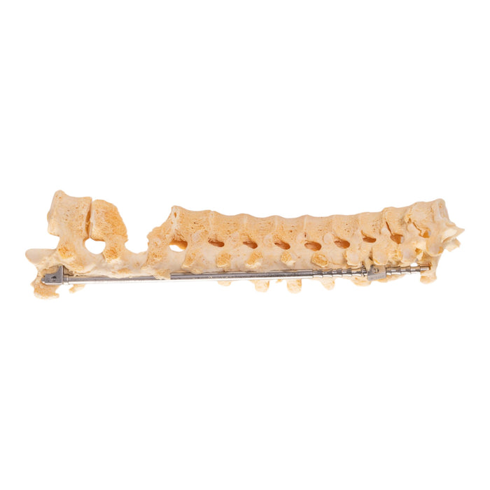 Real Human Skeleton - Partial - Pathology