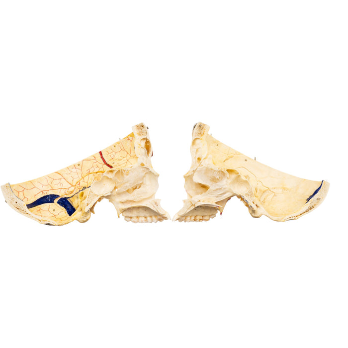Real Human Skull - Dissected - with Carrying Case