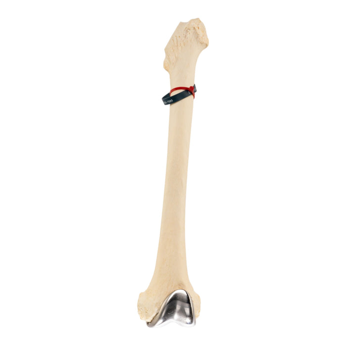 Real Human Femur - Pathology