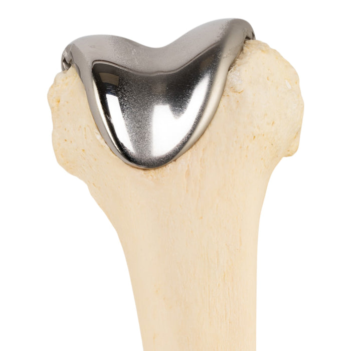 Real Human Femur - Pathology
