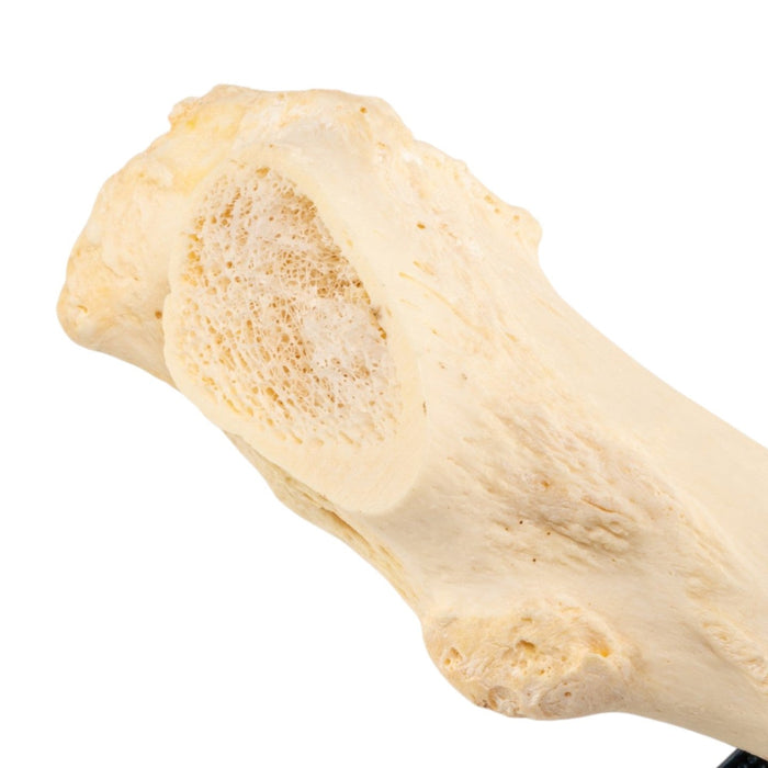 Real Human Femur - Pathology