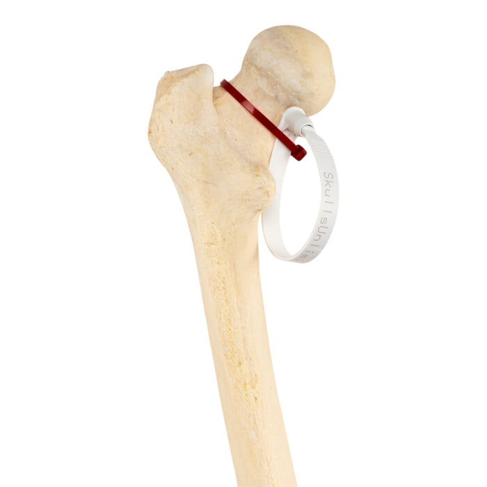 Real Human Femur - Pathology