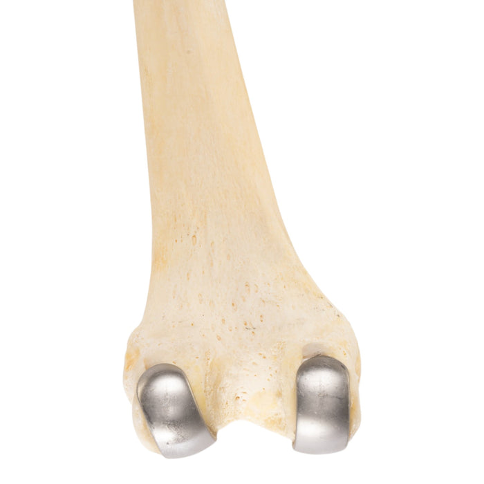Real Human Femur - Pathology