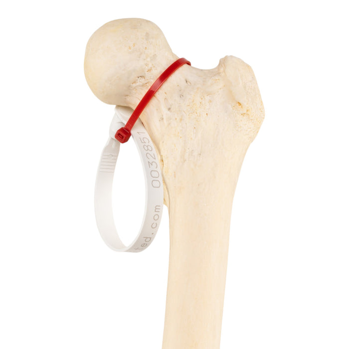 Real Human Femur - Pathology