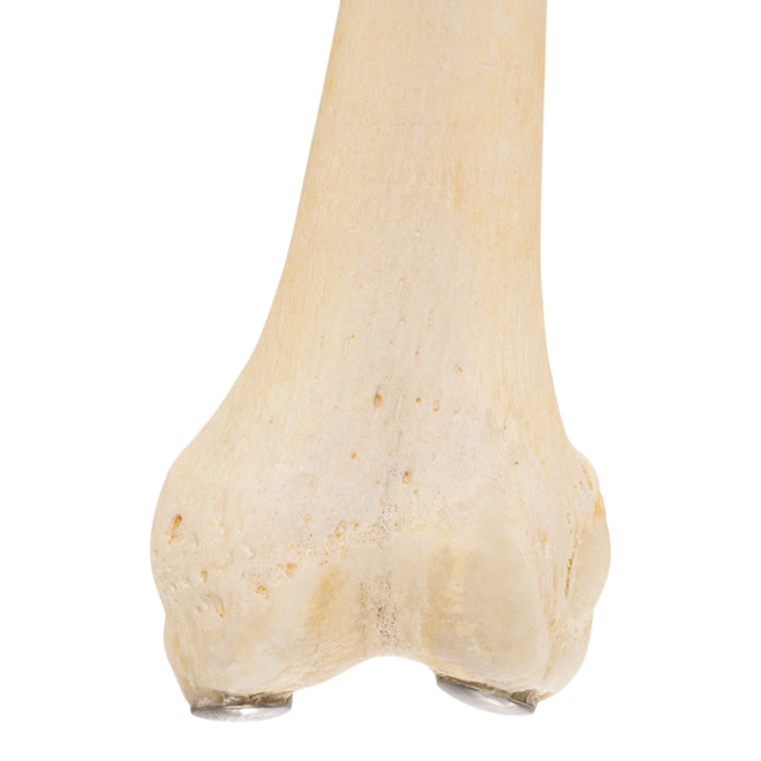 Real Human Femur - Pathology
