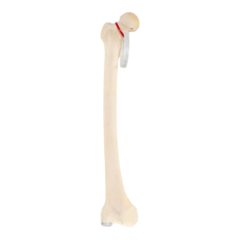 Real Human Femur - Pathology