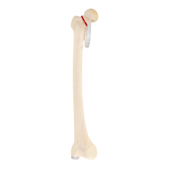 Real Human Femur - Pathology
