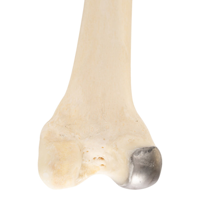 Real Human Femur - Pathology
