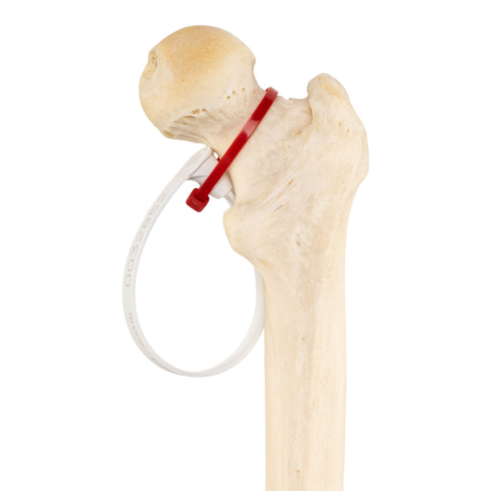 Real Human Femur - Pathology