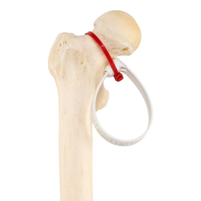 Real Human Femur - Pathology