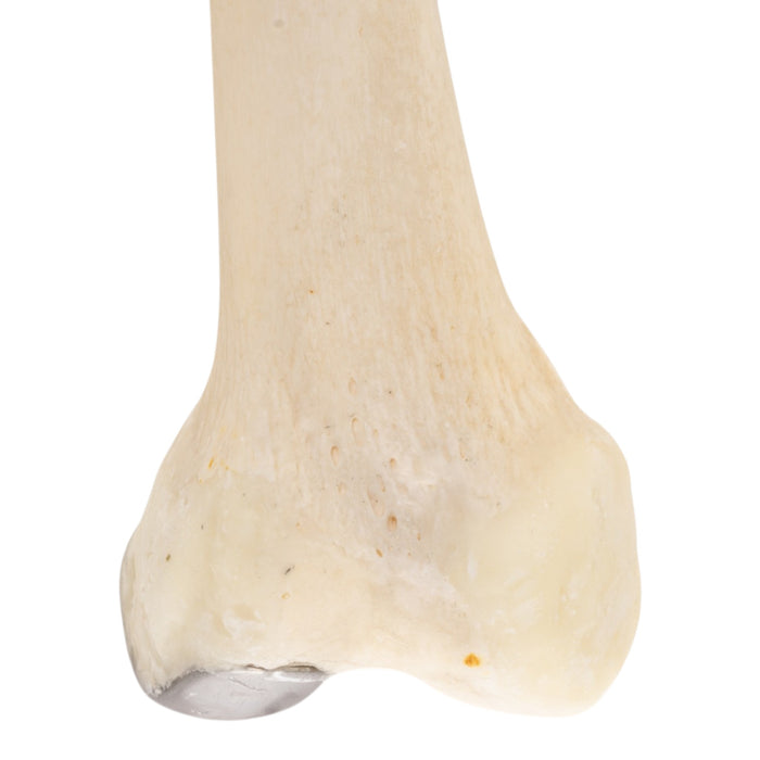 Real Human Femur - Pathology