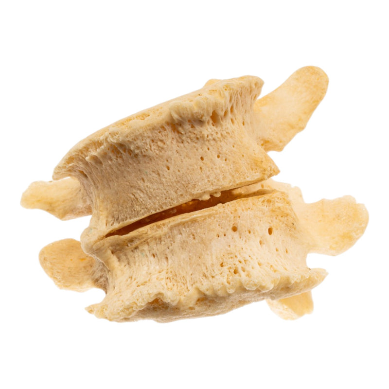 Real Human Lumbar Vertebrae - Fused