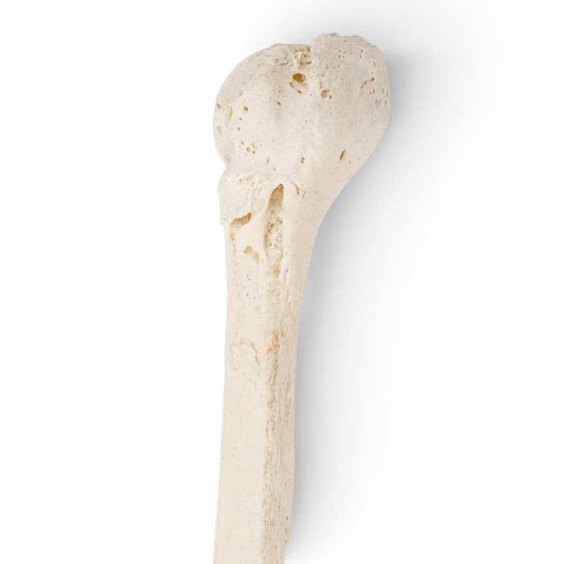 Real Human Humerus - Pathology