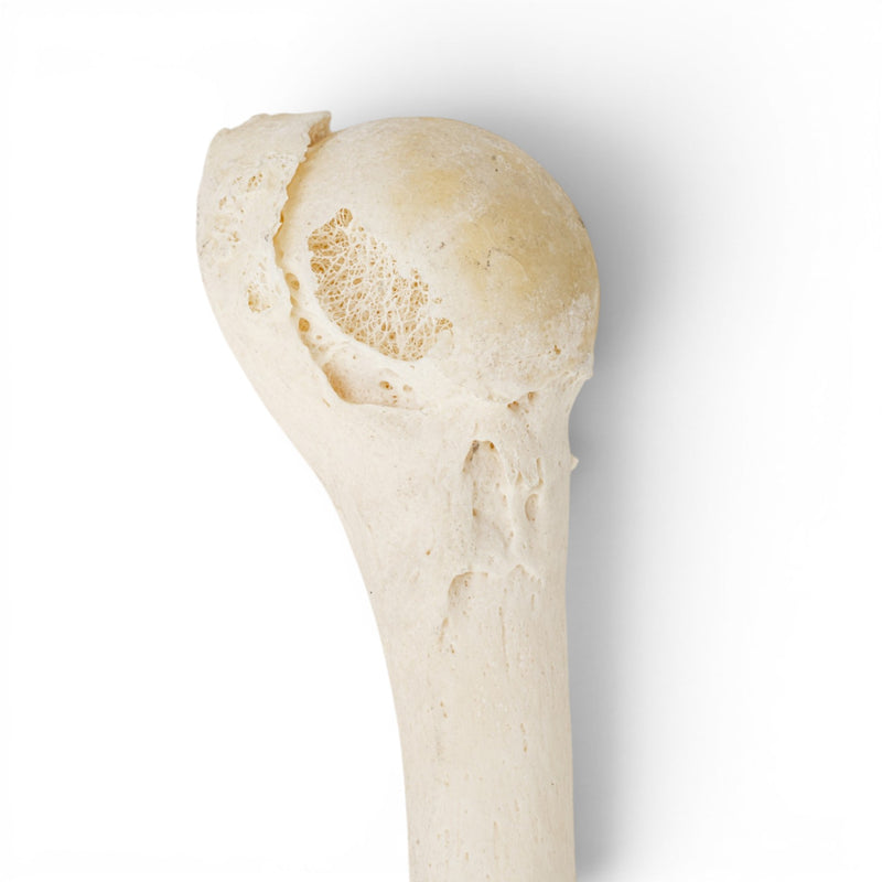Real Human Humerus - Pathology