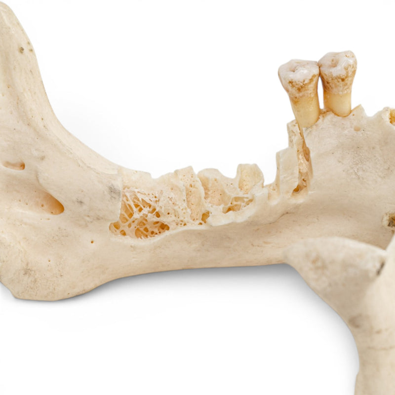 Real Human Mandible - Impaired