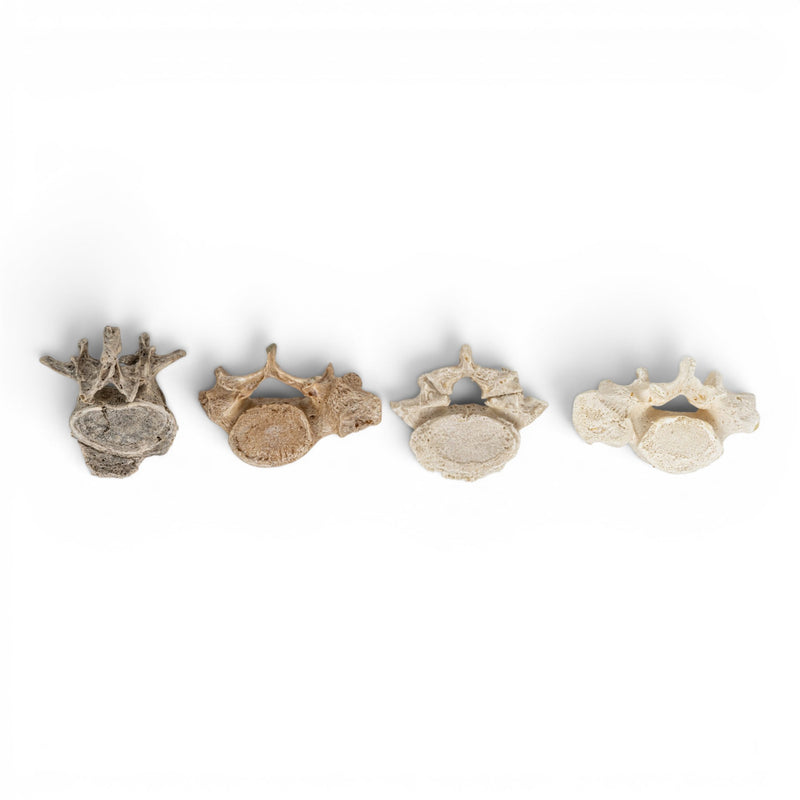 Real Human Lumbar Vertebrae Set - Pathology