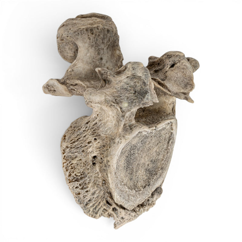Real Human Lumbar Vertebrae Set - Pathology