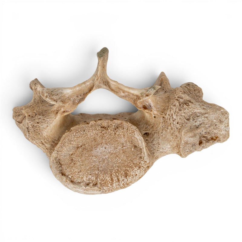 Real Human Lumbar Vertebrae Set - Pathology