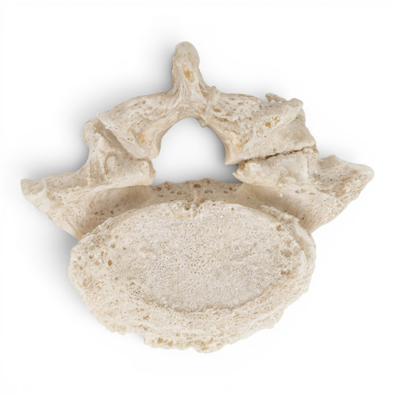 Real Human Lumbar Vertebrae Set - Pathology