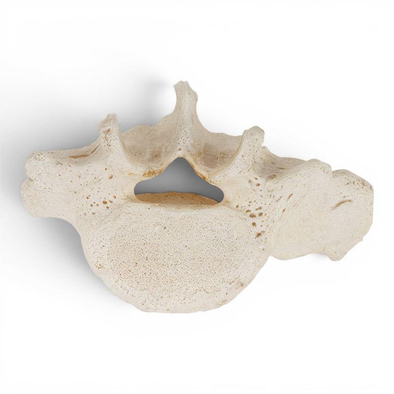 Real Human Lumbar Vertebrae Set - Pathology