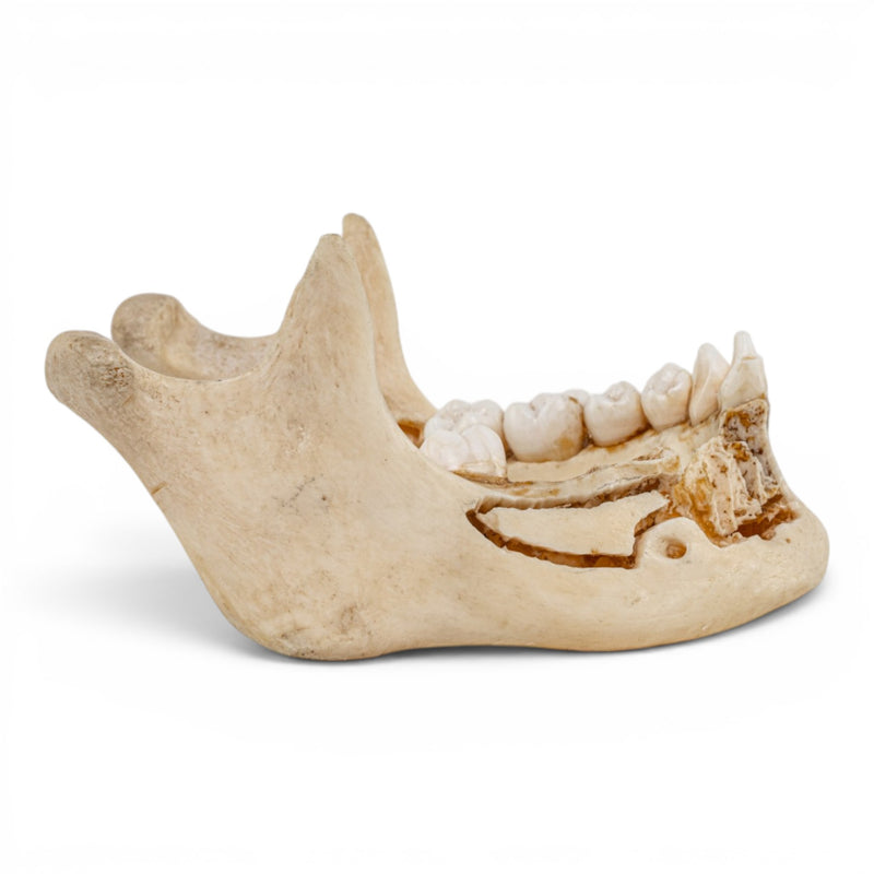 Real Human Mandible - Dissected