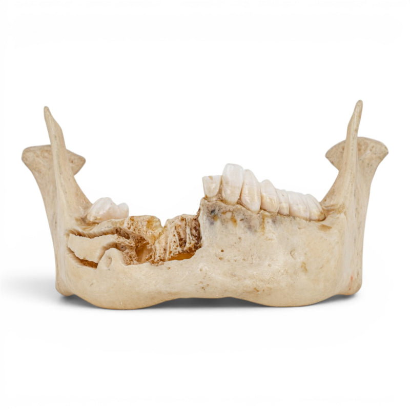 Real Human Mandible - Dissected