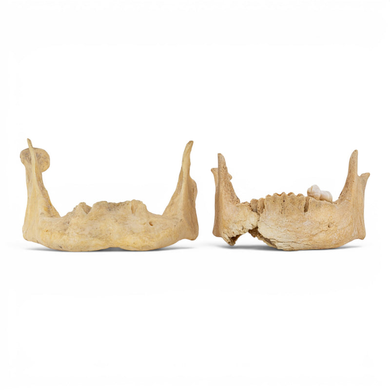 Real Human Mandible - Pathology - Set of 2