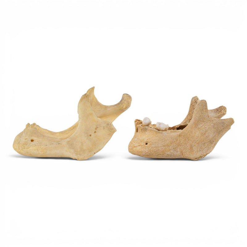 Real Human Mandible - Pathology - Set of 2