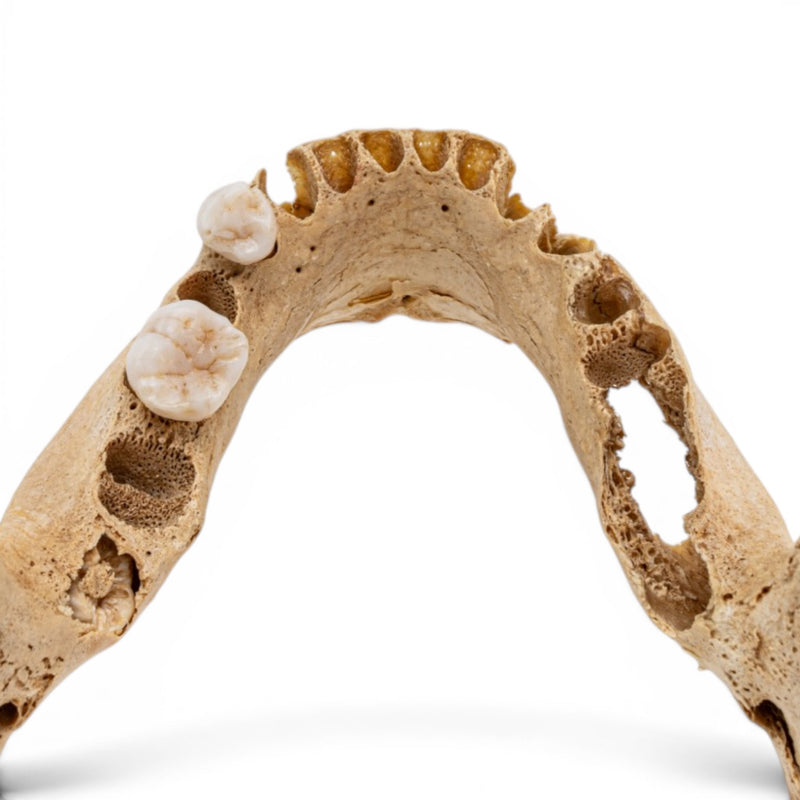Real Human Mandible - Pathology - Set of 2
