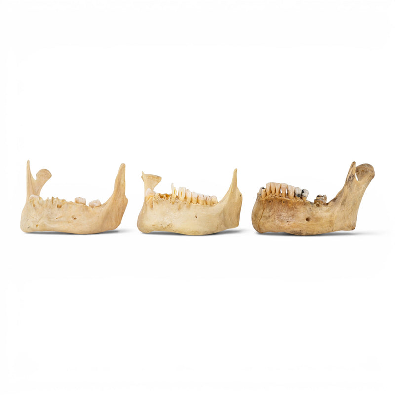Real Human Mandible - Pathology - Set of 3