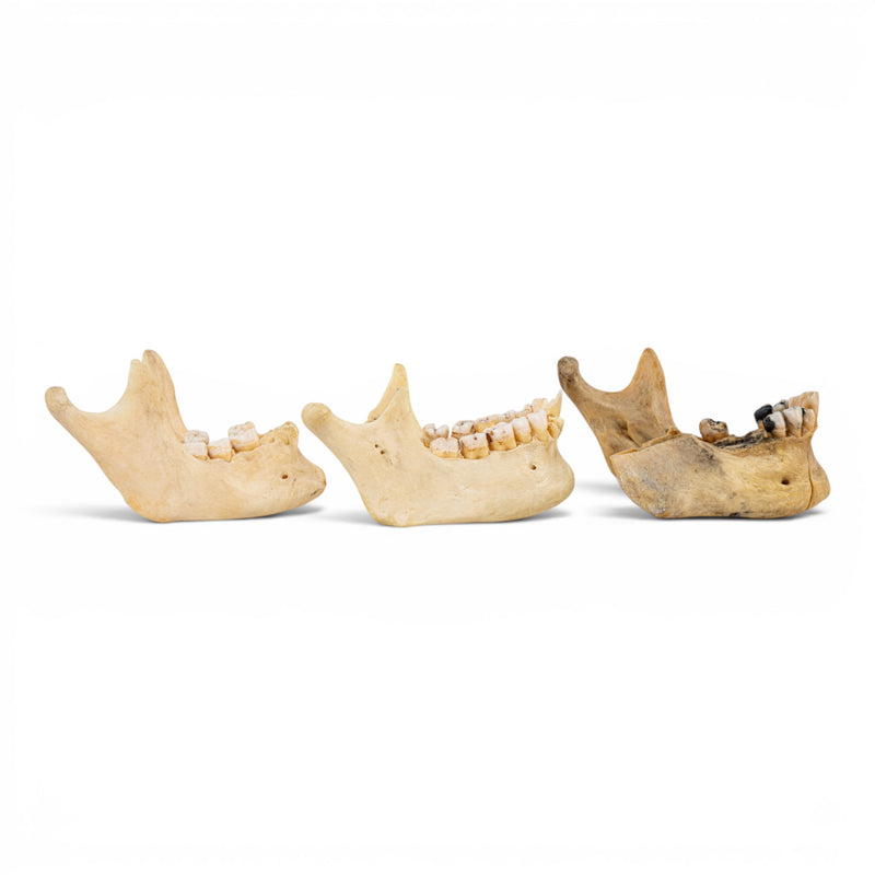 Real Human Mandible - Pathology - Set of 3