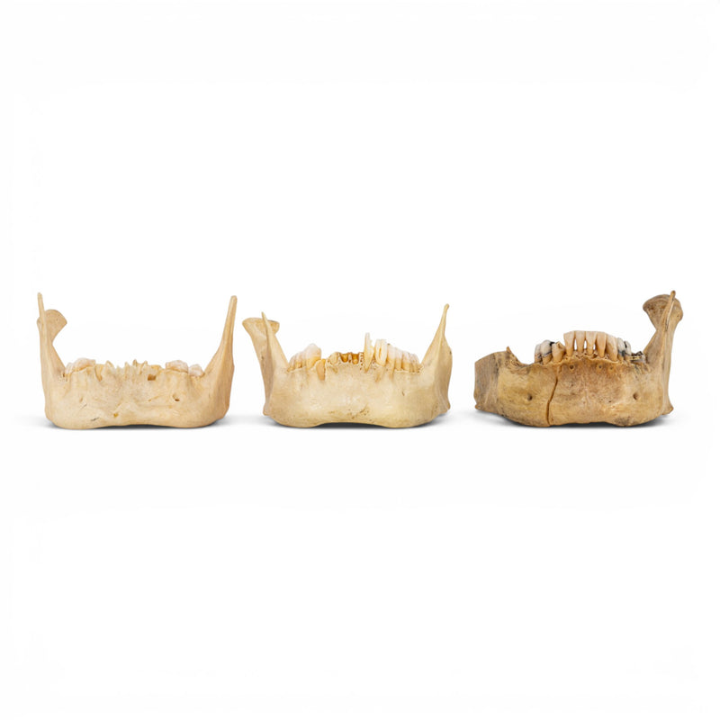 Real Human Mandible - Pathology - Set of 3