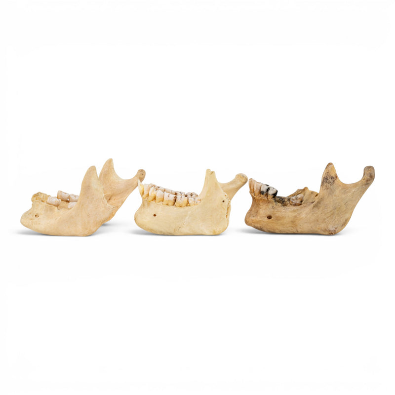 Real Human Mandible - Pathology - Set of 3